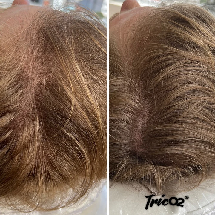 Resultado TricO2 antes e depois 1