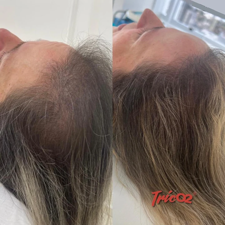 Resultado TricO2 antes e depois 2