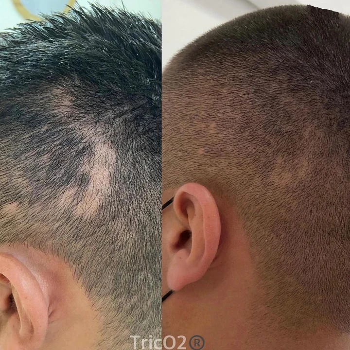 Resultado TricO2 antes e depois 3